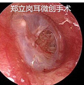 对于许多外伤性鼓膜穿孔的患者来说,大部分经过1-3个月的观察是可以