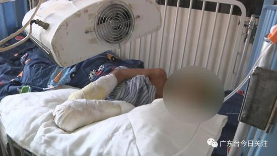 男童遭烫伤面临截肢,男童被火车撞伤截肢