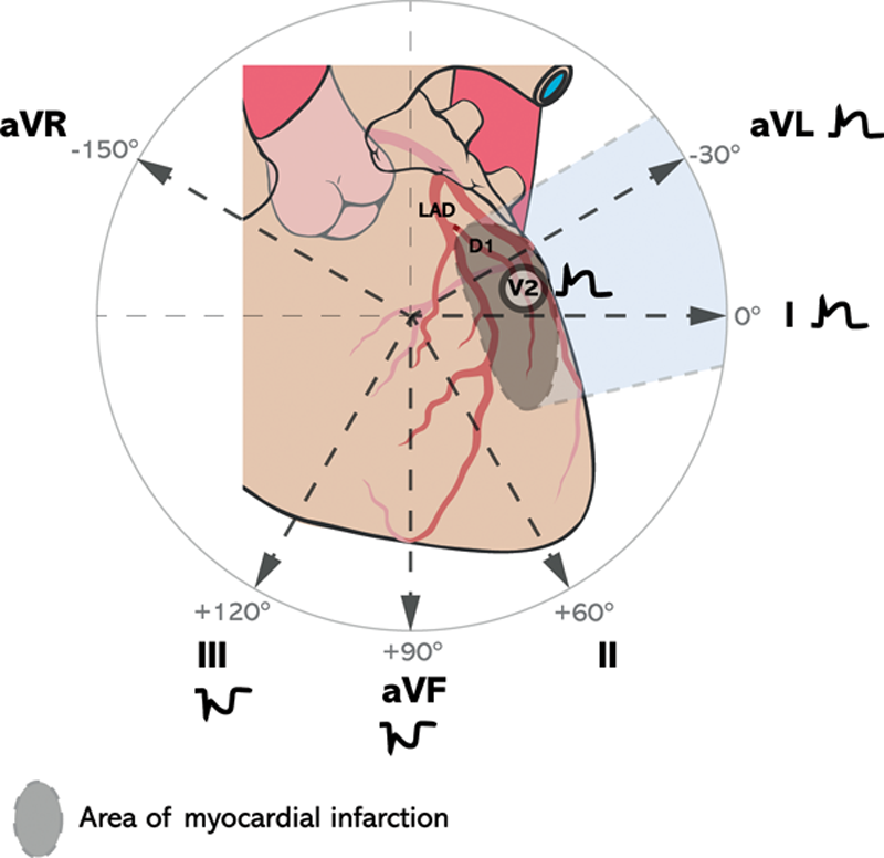 第一对角支闭塞引起的高侧壁心梗致使st段向量方向指向i,avl和v2导联