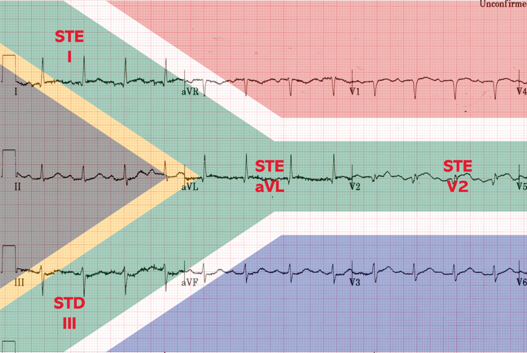 南非国旗含义英文(心电图上的「南非国旗征」，你是否会错过？)
