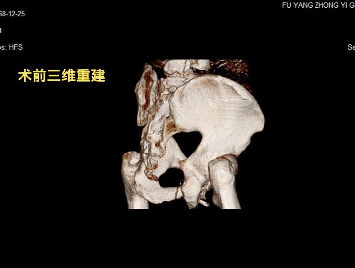 一捆钢管从天而降！他浑身上下多处被砸严重骨折，该如何化险为夷？