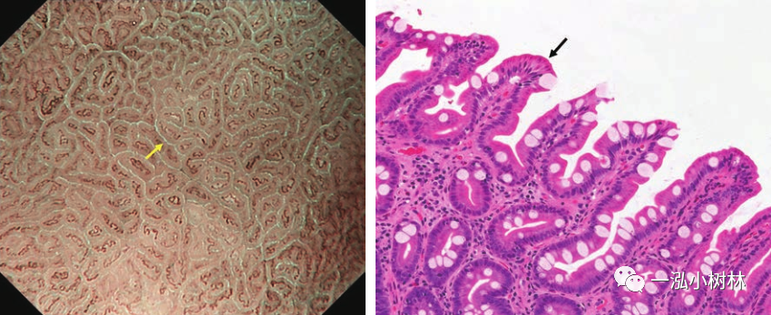 多中心性扩展的局部肠上皮化生黏膜的存在,可以适当地进行胃癌的危险