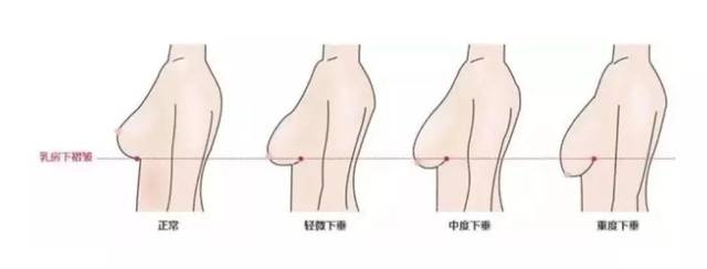 断奶后胸部干瘪松弛下垂，针对这种情况该怎么改善？