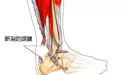 潍坊市中医院：“蹦”一声跟腱断裂，3厘米微创助他重返球场