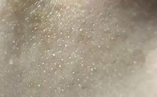 去黑頭，哪種方法最有效？