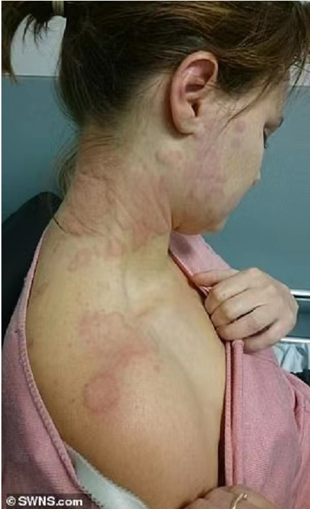 浑身荨麻疹因“对压力极度过敏”？英国一打工人裸辞旅行后不药而愈