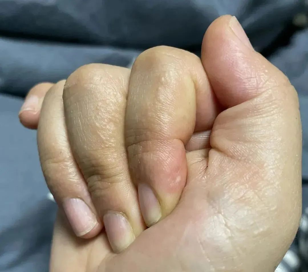 手上长脚气?夏天手指长出小水疱,又痒又痛!千万别抓破!