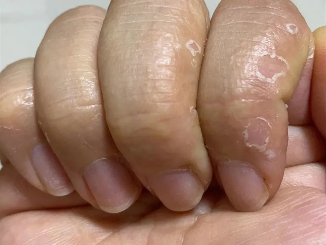 手上长脚气?夏天手指长出小水疱,又痒又痛!千万别抓破!