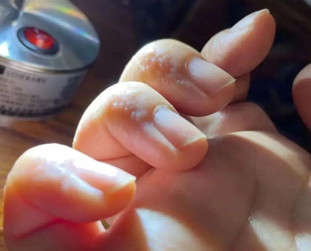 手上长脚气?夏天手指长出小水疱,又痒又痛!千万别抓破!