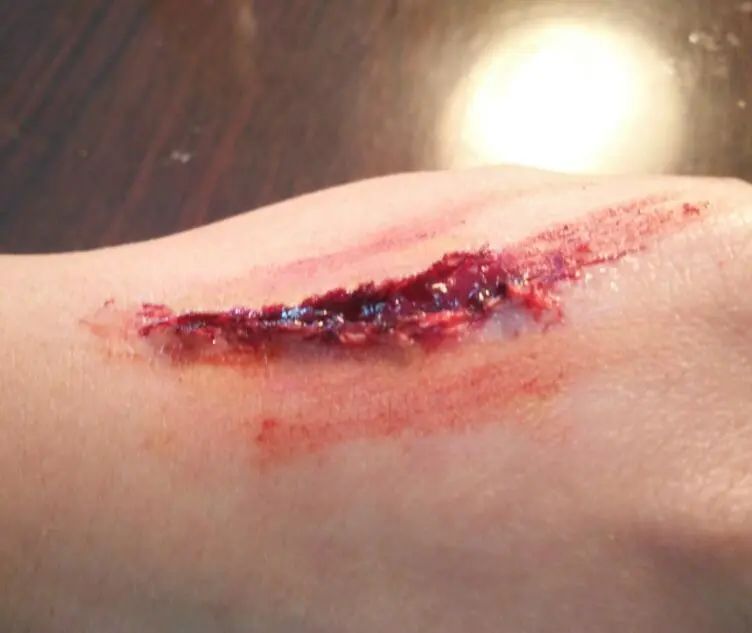 伤口有渗出液要贴创口贴吗「伤口有渗出液可以贴创可贴吗」-友友