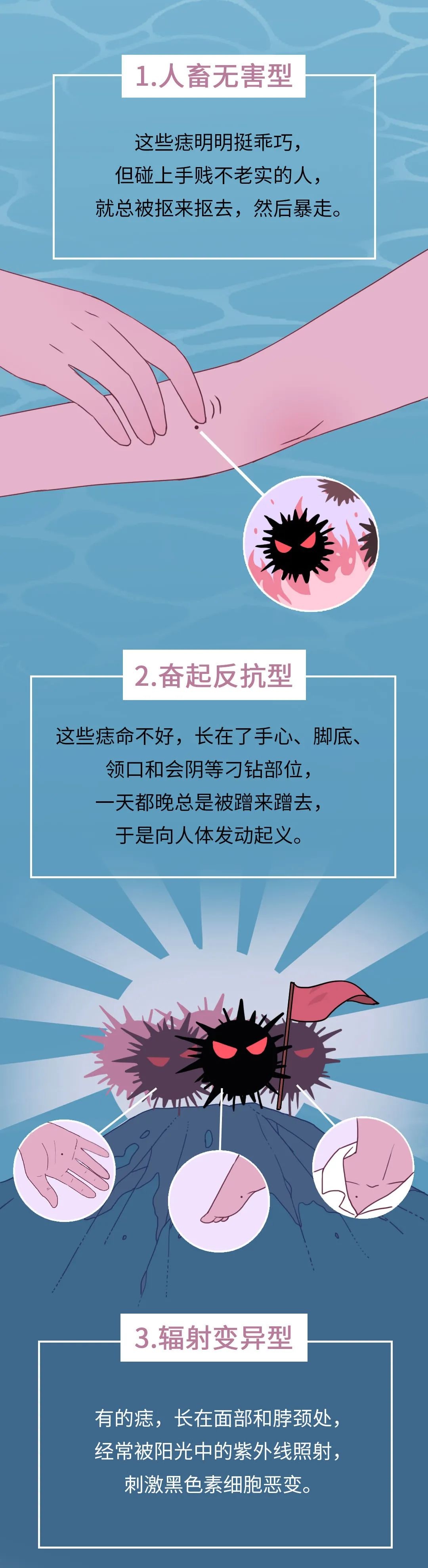 建议对照本文，仔细检查身上的痣！这种可能会癌变…