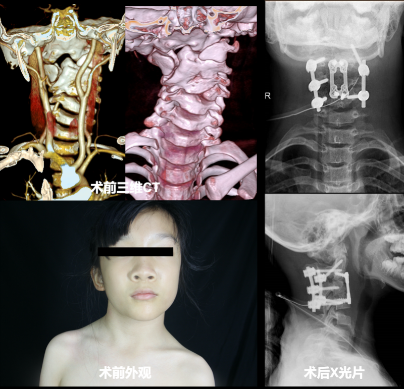 女孩颈椎畸形歪脖子，跨国商讨方案后广州医生帮其“正颈”