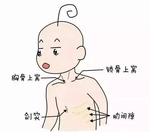 婴儿三凹征图片(这病很像感冒)