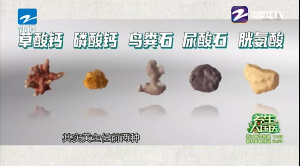 一般来说肾结石分为五类:草酸钙结石,磷酸钙结石,鸟粪石,尿酸结石,胱