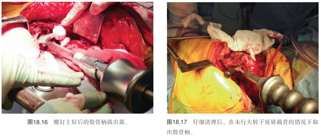 髋关节翻修术中股骨柄假体的取出（下）