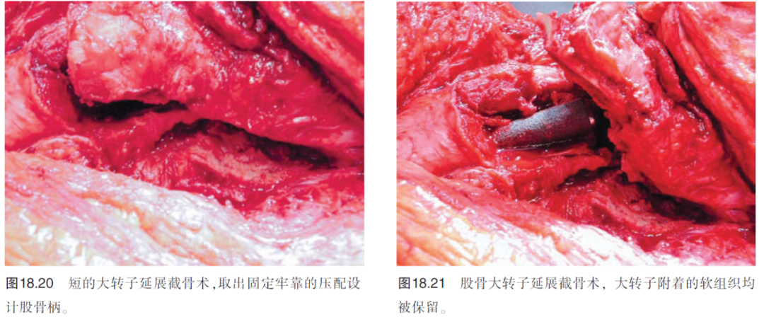 髋关节翻修术中股骨柄假体的取出（下）