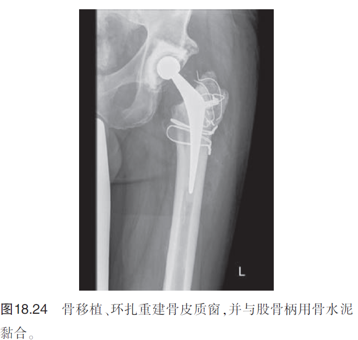 髋关节翻修术中股骨柄假体的取出（下）