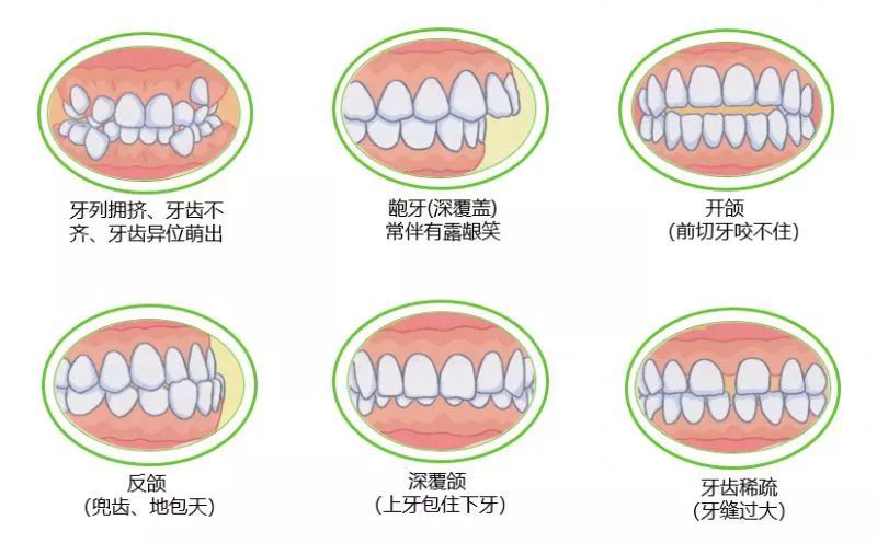 牙齿矫正的过程及注意事项