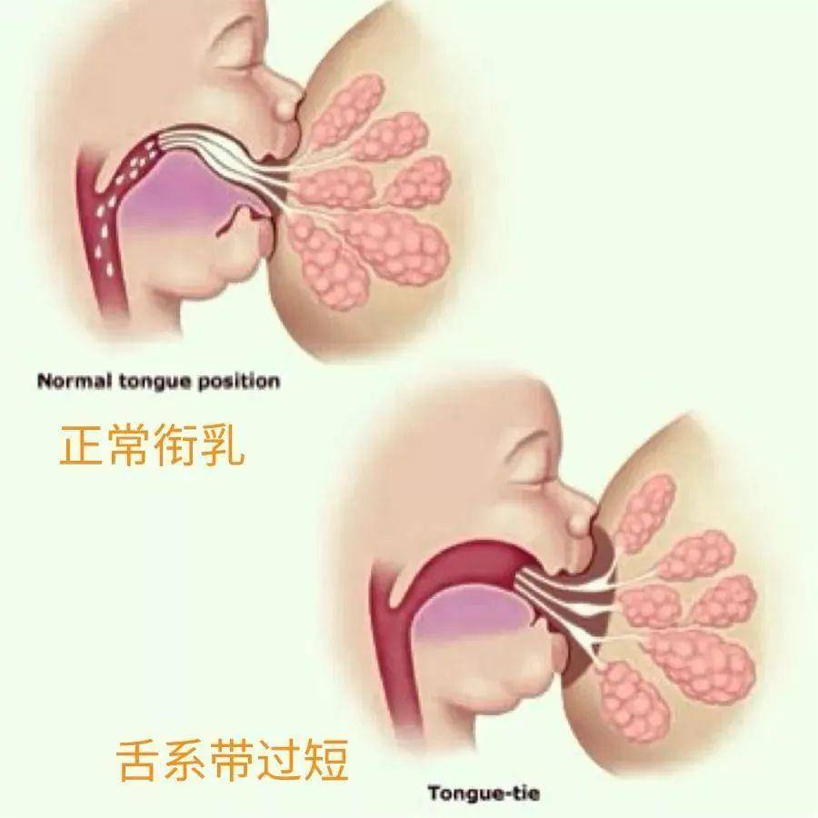 上唇舌系带过短图片图片