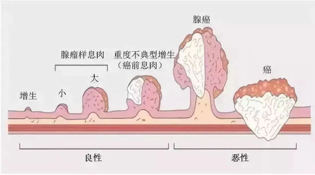 巨结肠分型图片