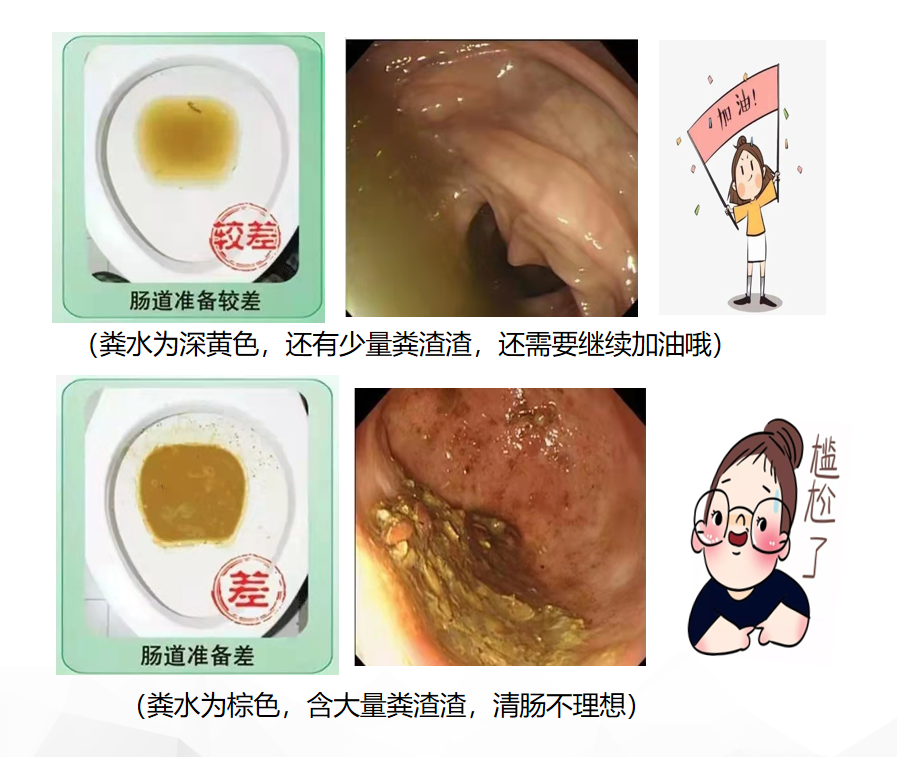 肠镜，一项能救命的检查！超全攻略来了