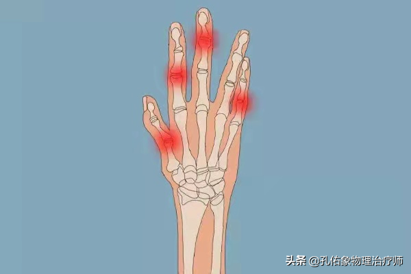 手指肿胀、僵硬、疼痛、有结节，挺挺就过去了？辟谣，趁早诊治
