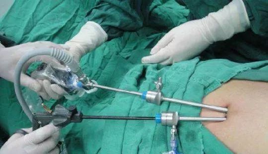 结扎是什么意思 结扎是什么-人人投票