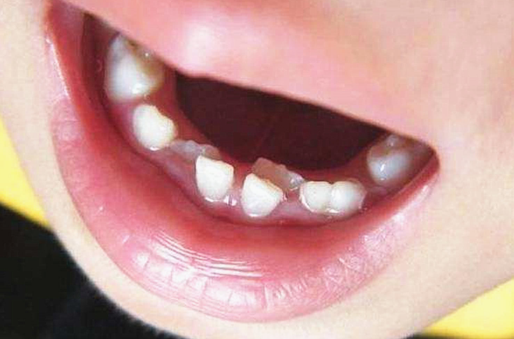 儿童门牙长歪图片(宝宝旧牙整齐) - 赤虎壹号