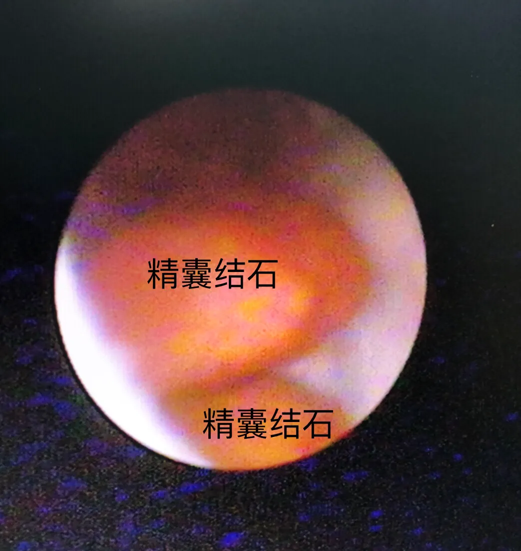 男科手术探秘6:精囊炎血精、精囊结石和精囊镜手术、钬激光碎石