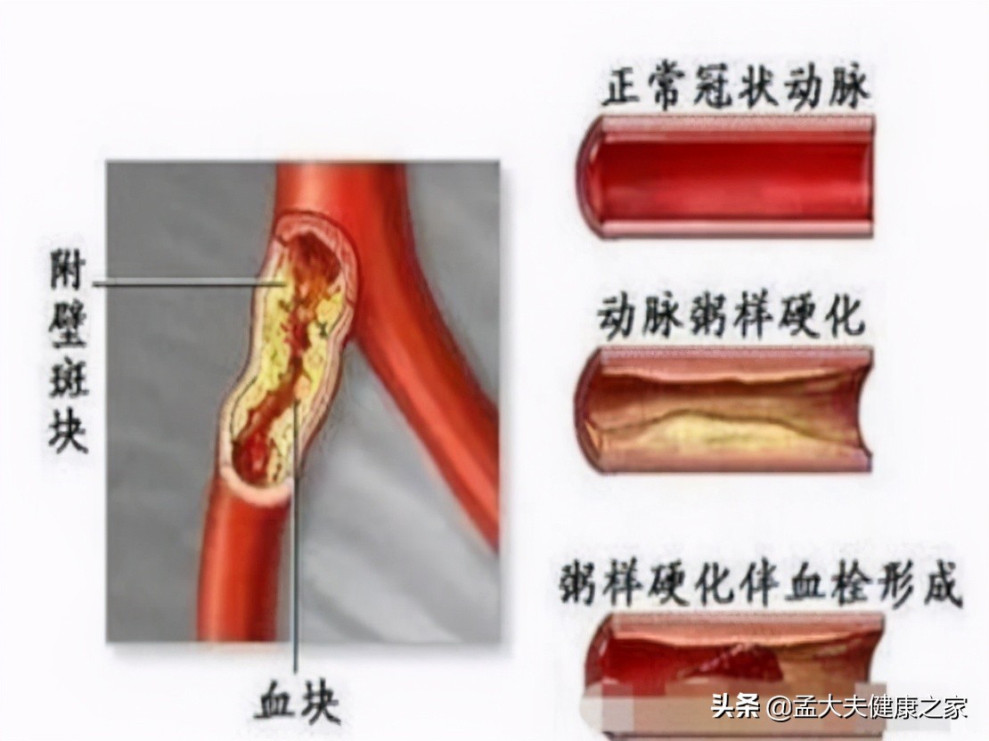 患有冠心病服用这2种药物，有效减少心肌缺血发作，提高生活质量