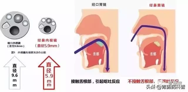 关于胃肠镜检查的18个疑问