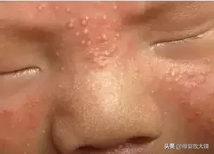 红斑、脱皮、痤疮…新生儿最易出现的10种皮肤问题，宝妈护理必备