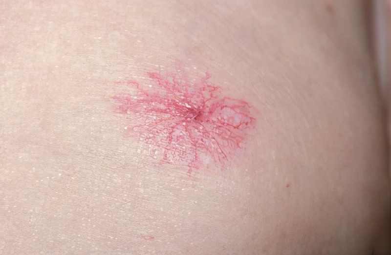 肝掌图片高清图片 肝掌最简单的恢复方法-始兴思宇科技