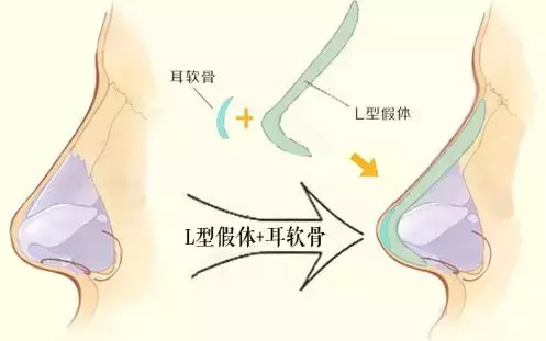 最漂亮的3种鼻子，第1种很少有人有