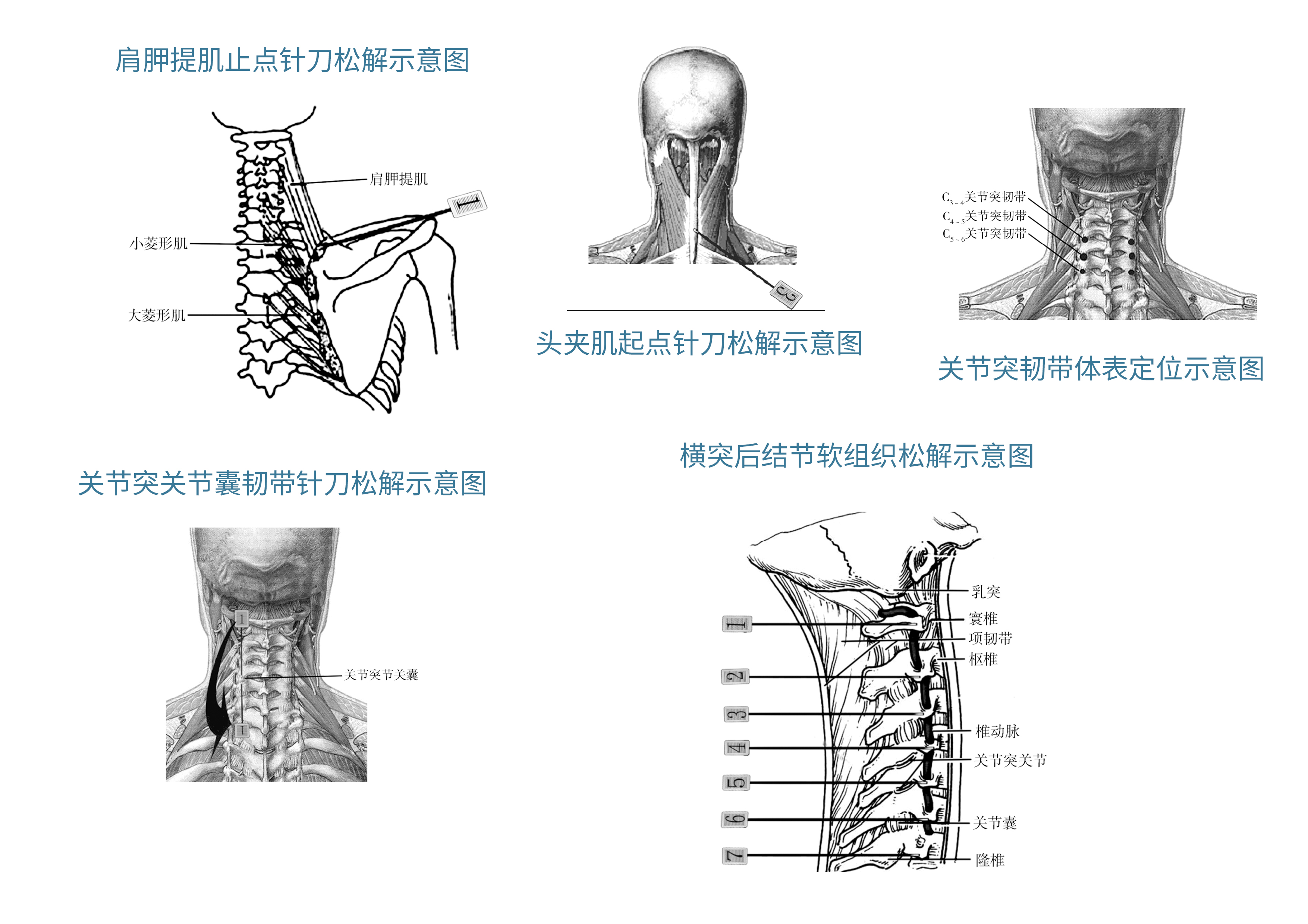 小针刀治疗颈椎病是骗人的吗？医生告诉你真相