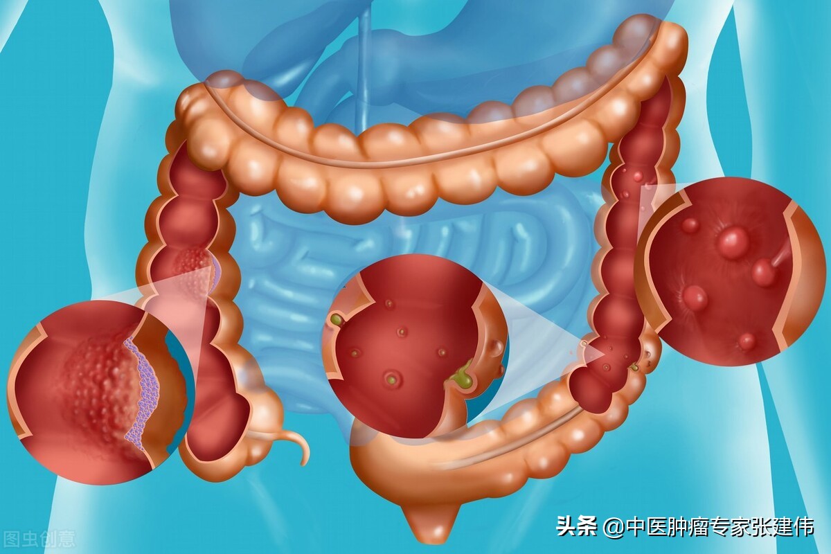 肠息肉手术后勿放松警惕，应注意这些，尤其要警惕癌变