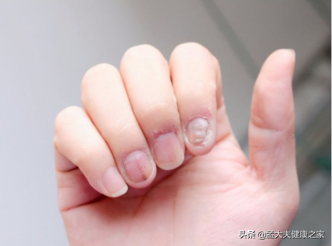 灰指甲治疗方法及护理建议