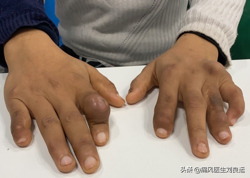 痛风患者都会长出痛风石吗？医生介绍痛风石治疗的四种方法