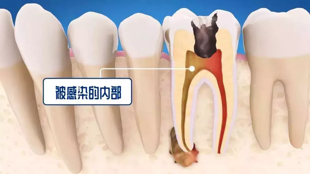 牙疼后为什么医生建议你根管治疗而不是补牙