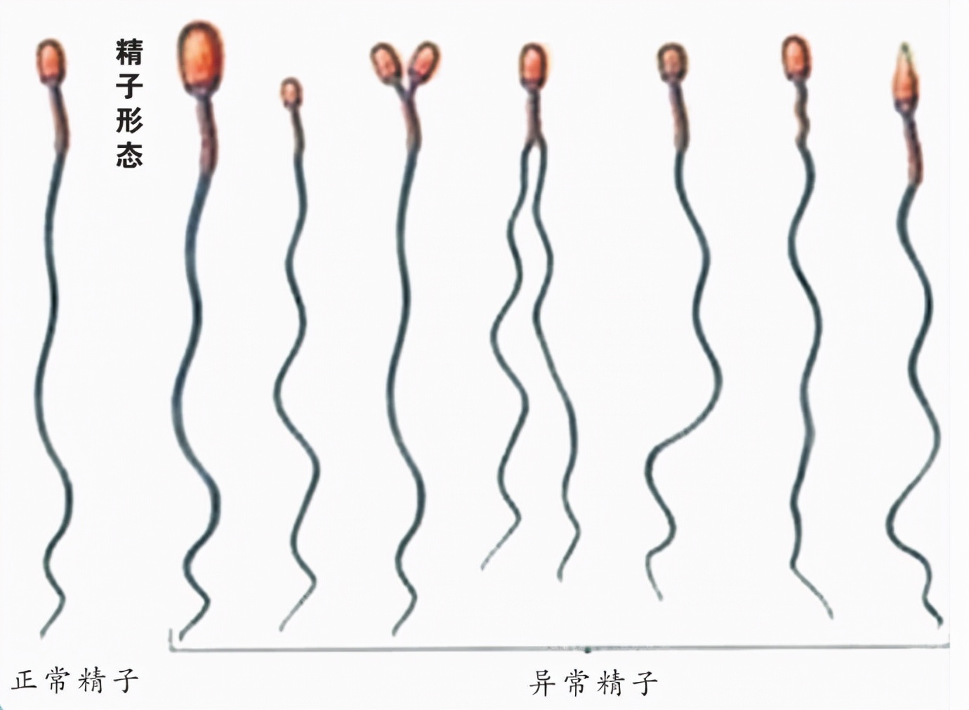 英国女子自己操作人工授精，一次成功！普通人千万不要尝试