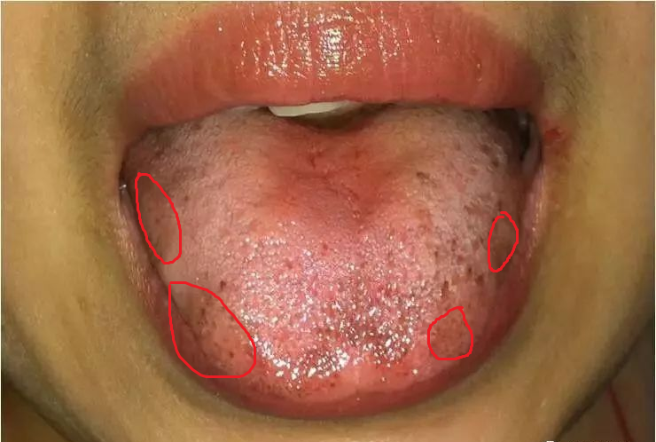 二,看图说话,瘀血体质的人舌头是什么样的?