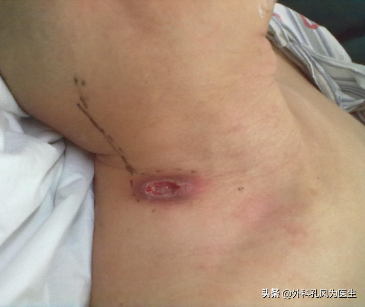 淋巴结核,中医称为瘰疬,又称"老鼠疮","鼠疬".多见于儿童和青年人.