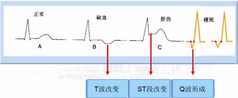 1份30元的心电图，可直接诊断出5种常见心脏病，辅助诊断4种病