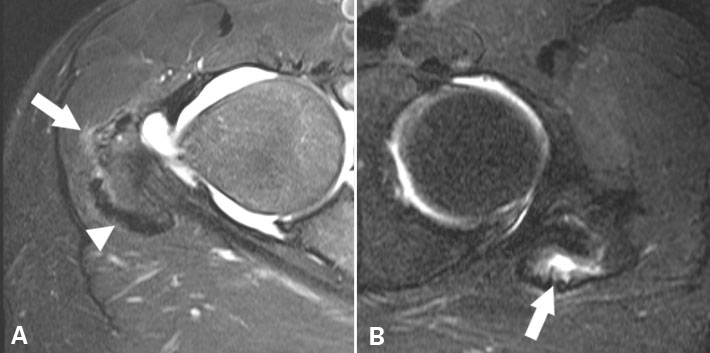 髋关节有积液了咋办？医生：千万不能一消了事！