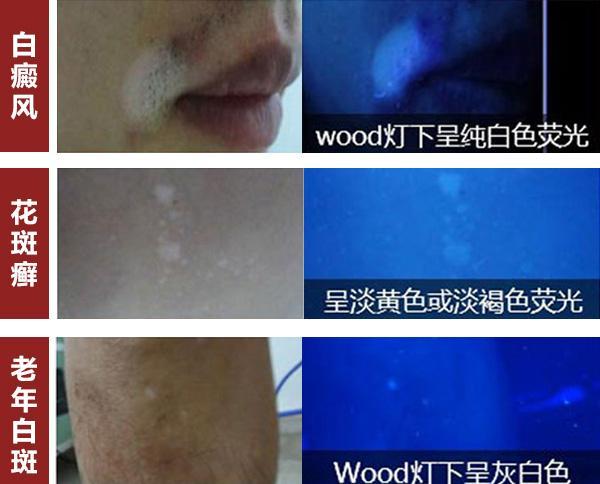 白斑≠白癜风，还可能是这4种皮肤疾病，别搞错了