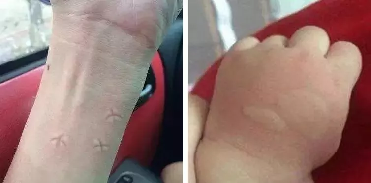 携带病毒、传染疾病！蚊虫叮咬别大意，这种情况赶快就医