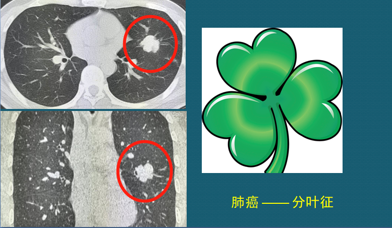 从CT片上看肺癌结节，有4个常见表现，医生教你入门学CT