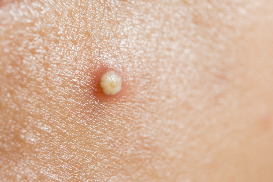 私处长痘千万别抠,可能是尖锐湿疣