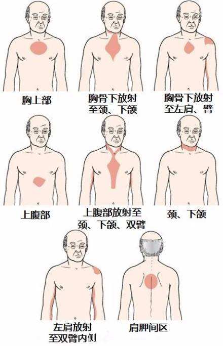 一文读懂什么是心肌缺血？都有什么症状？如何预防和急救？