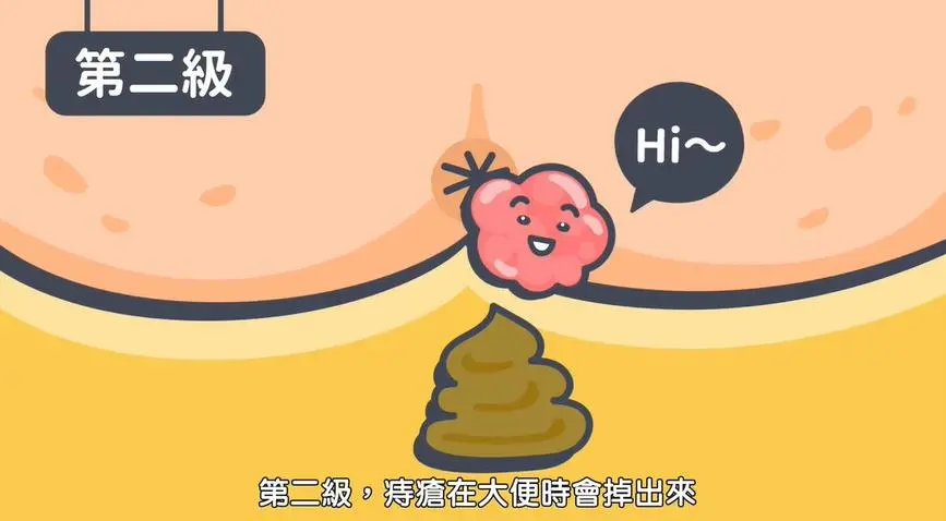 便秘+痔疮,千万别自行用药,当心越用越糟